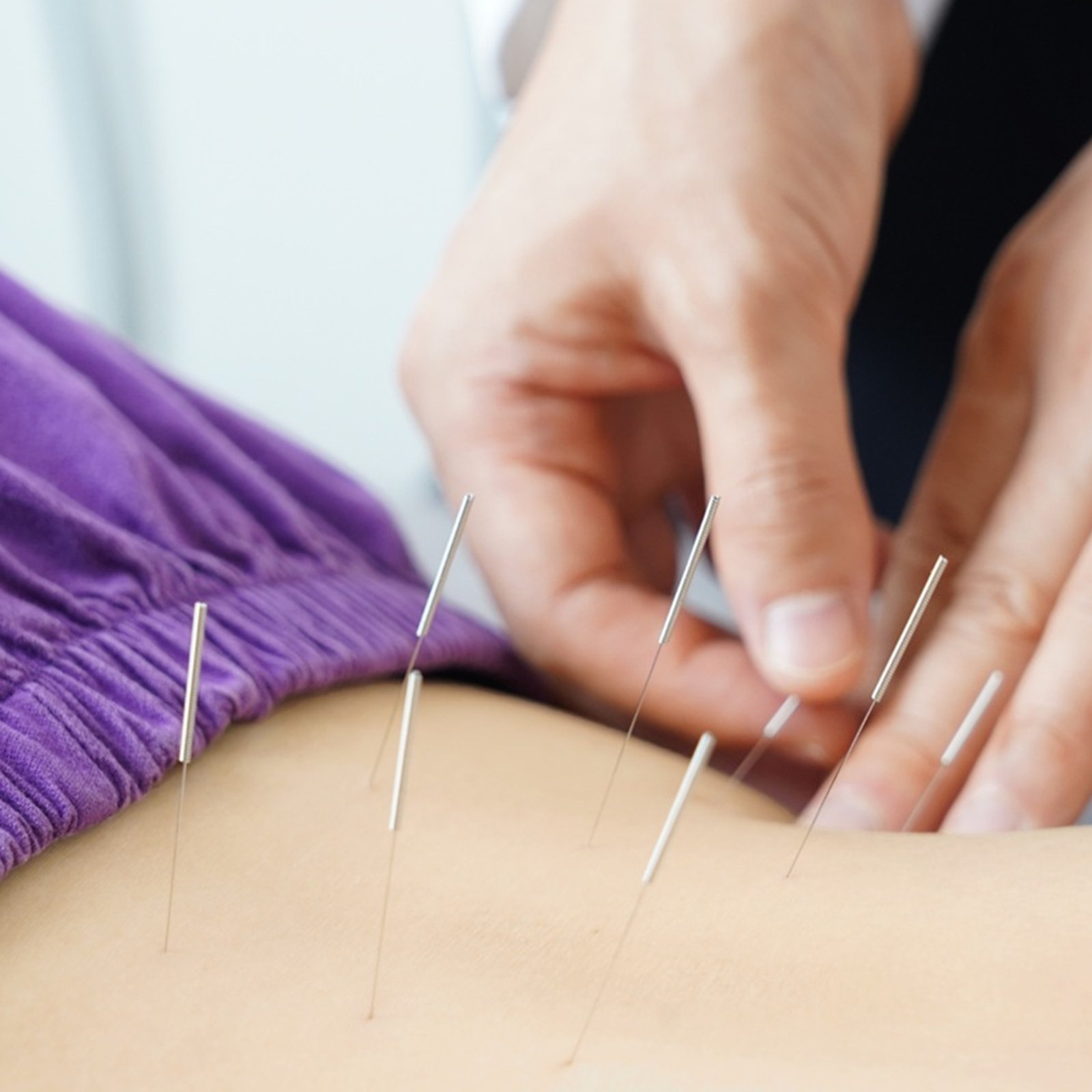 Dry Needling Therapy